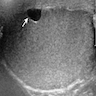 Chronic hydrocele with multiloculated appearance