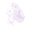 Lipoma-like WDLPS: retroperitoneum, excision