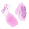 Sclerosing WDLPS: retroperitoneum, excision