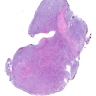 MLPS: soft tissue, thigh, excision