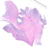 MLPS: abdomen, excision
