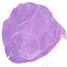 PLPS: soft tissue, lower leg, excision