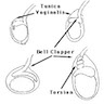 Bell clapper deformity leading to intravaginal testicular torsion
