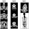 CT for staging