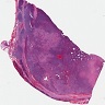 Sarcomatoid pattern, ATC