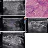 Ultrasonographic features of DSV PTC