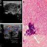 Ultrasonographic features of DSV PTC