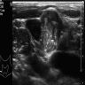 Ultrasonographic features of DSV PTC