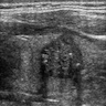 Ultrasound