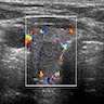 Color doppler sonogram