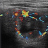 Color doppler sonogram