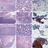 Thyroid neoplasms