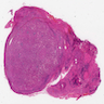 Oncocytic nodule