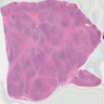 Fibrous variant of Hashimoto thyroiditis