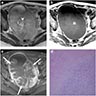 MRI findings