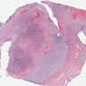 <i>YWHAE-NUTM2A/B</i> high grade endometrial stromal sarcoma