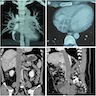 Intravenous leiomyomatosis - Contrast enhancing CT