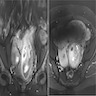 Intravenous leiomyomatosis - Magnetic resonance imaging
