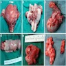Intravenous leiomyomatosis
