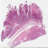 Hysterectomy from 80 year old with postmenopausal bleeding