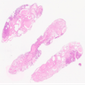 81 year old with endometrial polyp