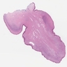 Fibroepithelial stromal polyp of vulva