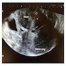 Vaginal angiomyofibroblastoma: ultrasound