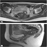 Vaginal angiomyofibroblastoma: MRI
