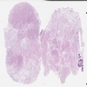 Vaginal: focal adipocytic differentiation
