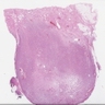Cellular angiofibroma of the vulva