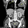 CT, proximal type with lung metastases