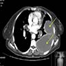 CT, proximal type with lung metastases