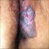 Lesion on perineal area