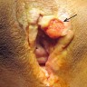 Ulcerative lesion, upper labia minor