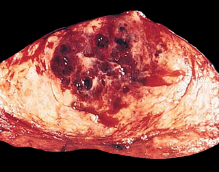 Postradiation angiosarcoma