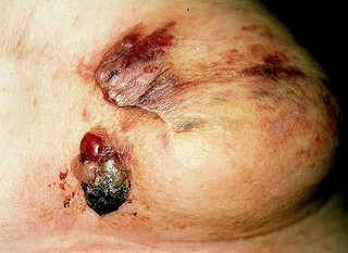 Postradiation angiosarcoma