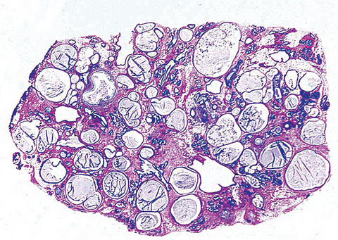 Florid papillomatosis of the nipple pathology outlines