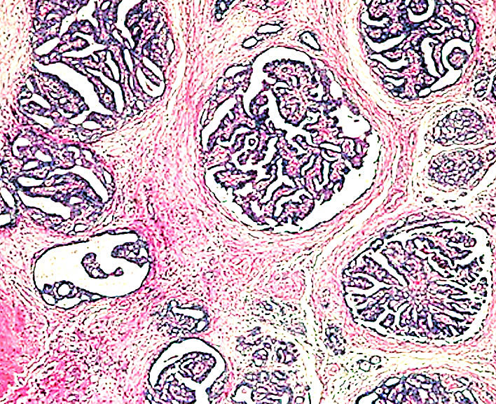 Florid papillomatosis, Florid papillomatosis of the nipple pathology outlines
