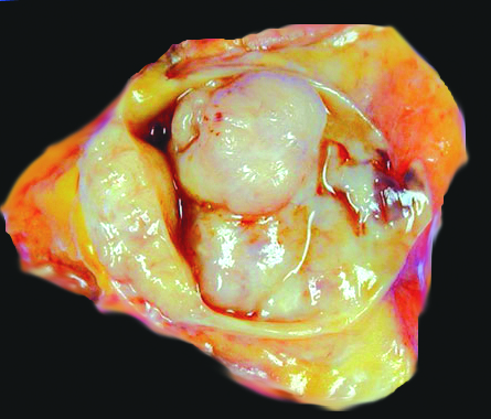 intraductal papilloma gross