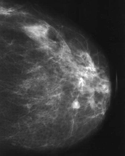 ductal papilloma mammogram)