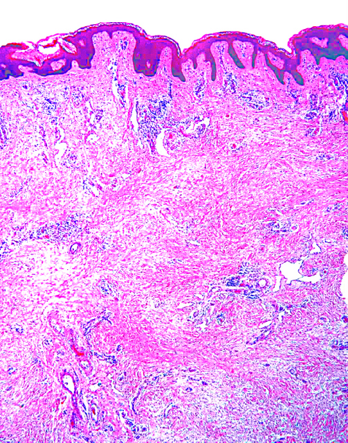 Pseudosarcoma – massive localized lymphoedema in morbidly obese – a rare  entity: Case report - ScienceDirect