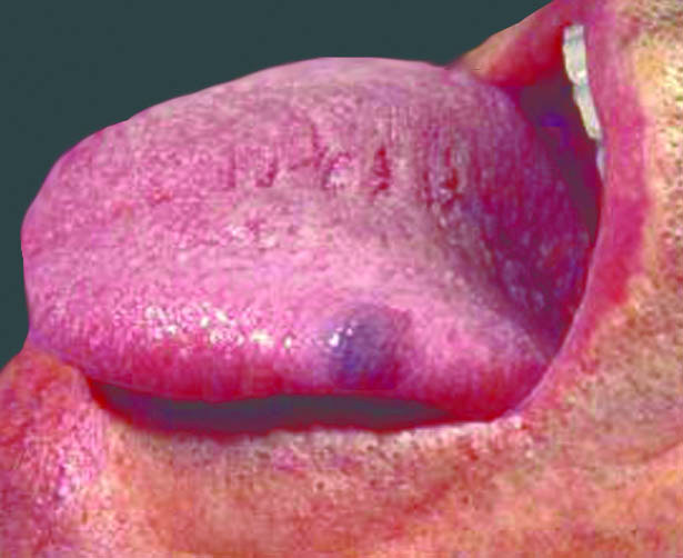 Tongue lesion