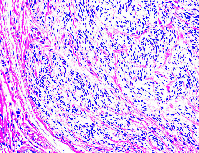 Pathology Outlines Palisaded Encapsulated Neuroma