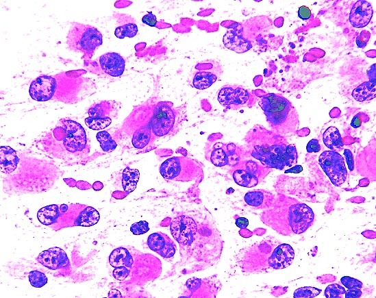 Rhabdoid cells in smears