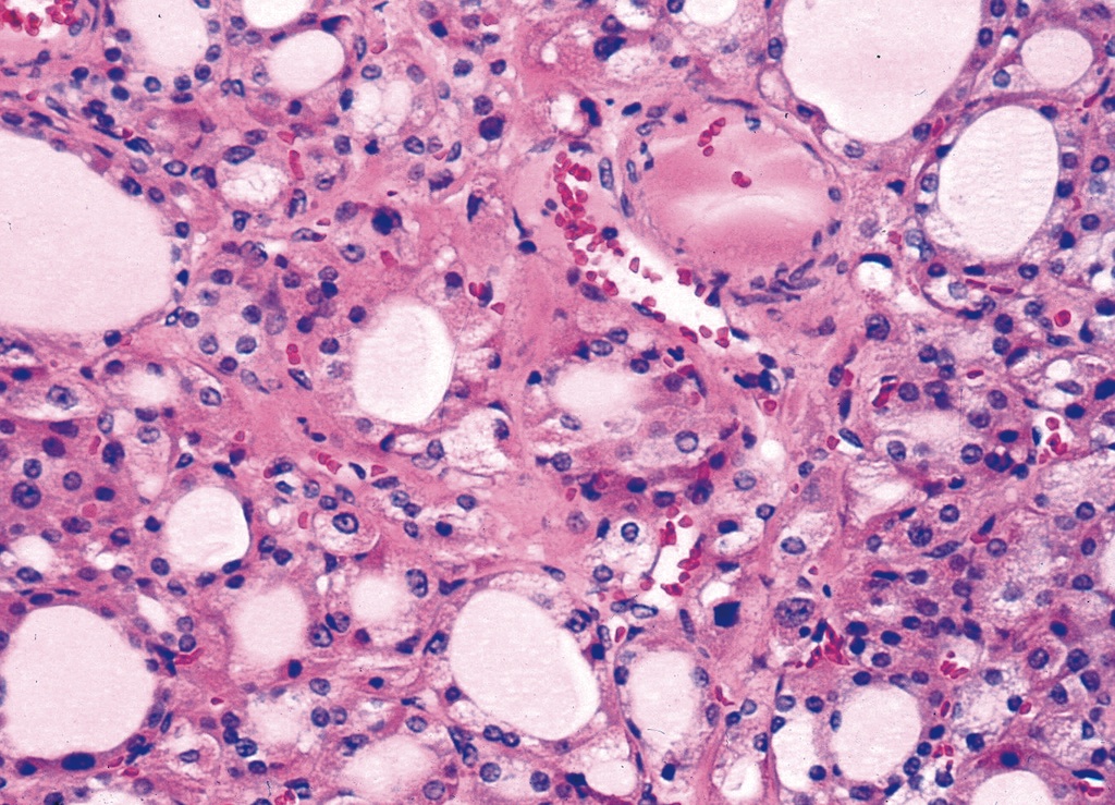 Pathology Outlines - Oncocytic (Hürthle cell) tumors